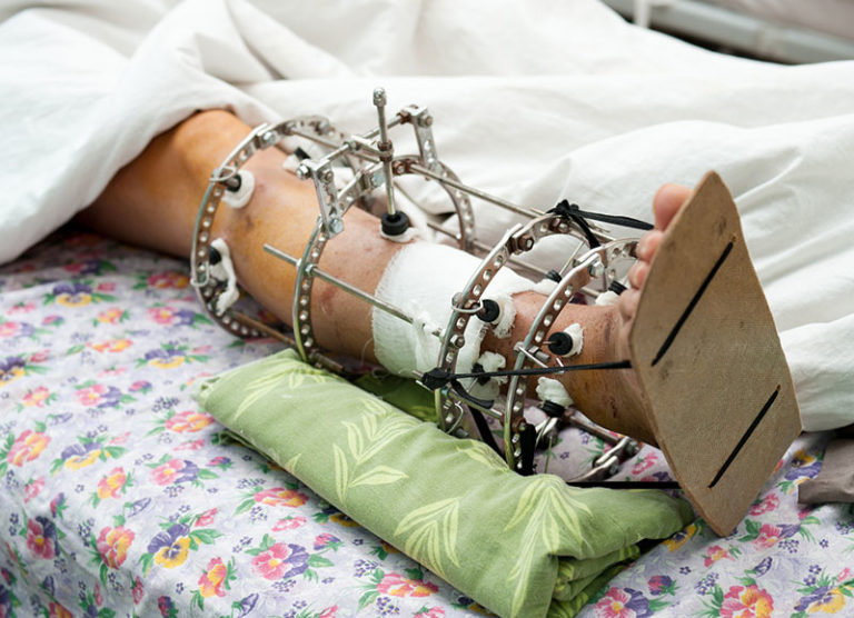 Przekaż swój 1% podatku na leczenie i rehabilitację nóżki Kubusia z Gliwic