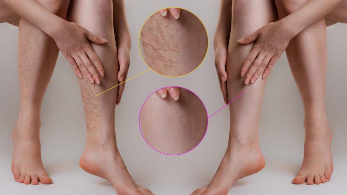 Leczenie zylakow termoablacja radiowa metoda RFITT Celon