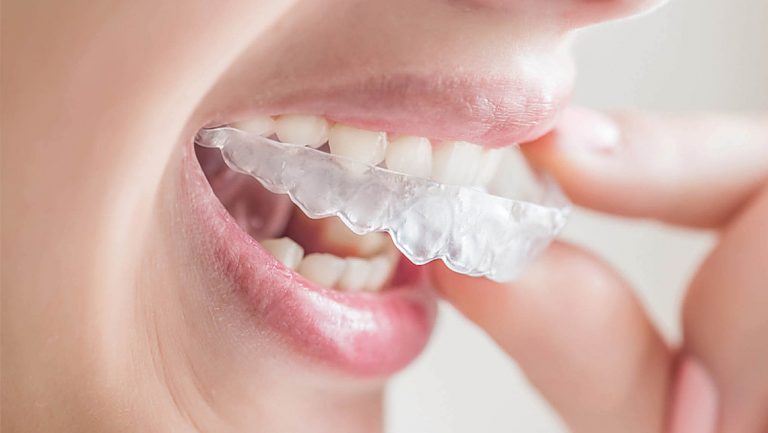 Aparat stały czy nakładka Invisalign dla dziecka? Wszystko co musisz wiedzieć o Invisalign