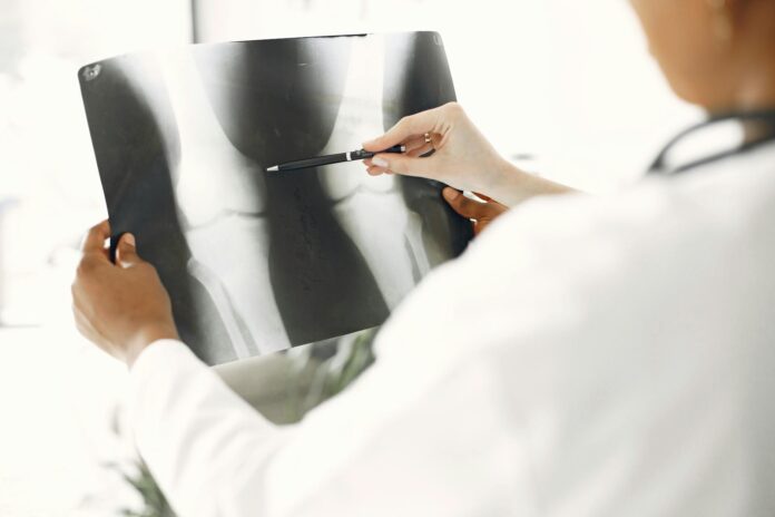 Narośla kostne (osteofity) – czym są i skąd się biorą